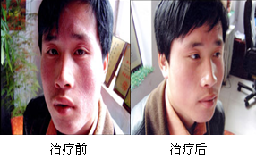 Ö£ÖÝ·ô¿µÆ¤·ô²¡Ñо¿ËùƤÑ׿µ¸´¶Ô±Èͼ