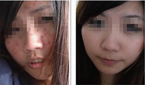 祛除牛皮癣 迎接爱情之花